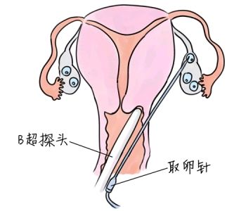 小儿退烧推拿手法 5种保定捐卵宝宝退烧按摩方法